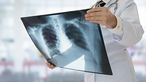 Baja por primera vez en 5 años la incidencia de enfermedades respiratorias causadas por la contaminación<
